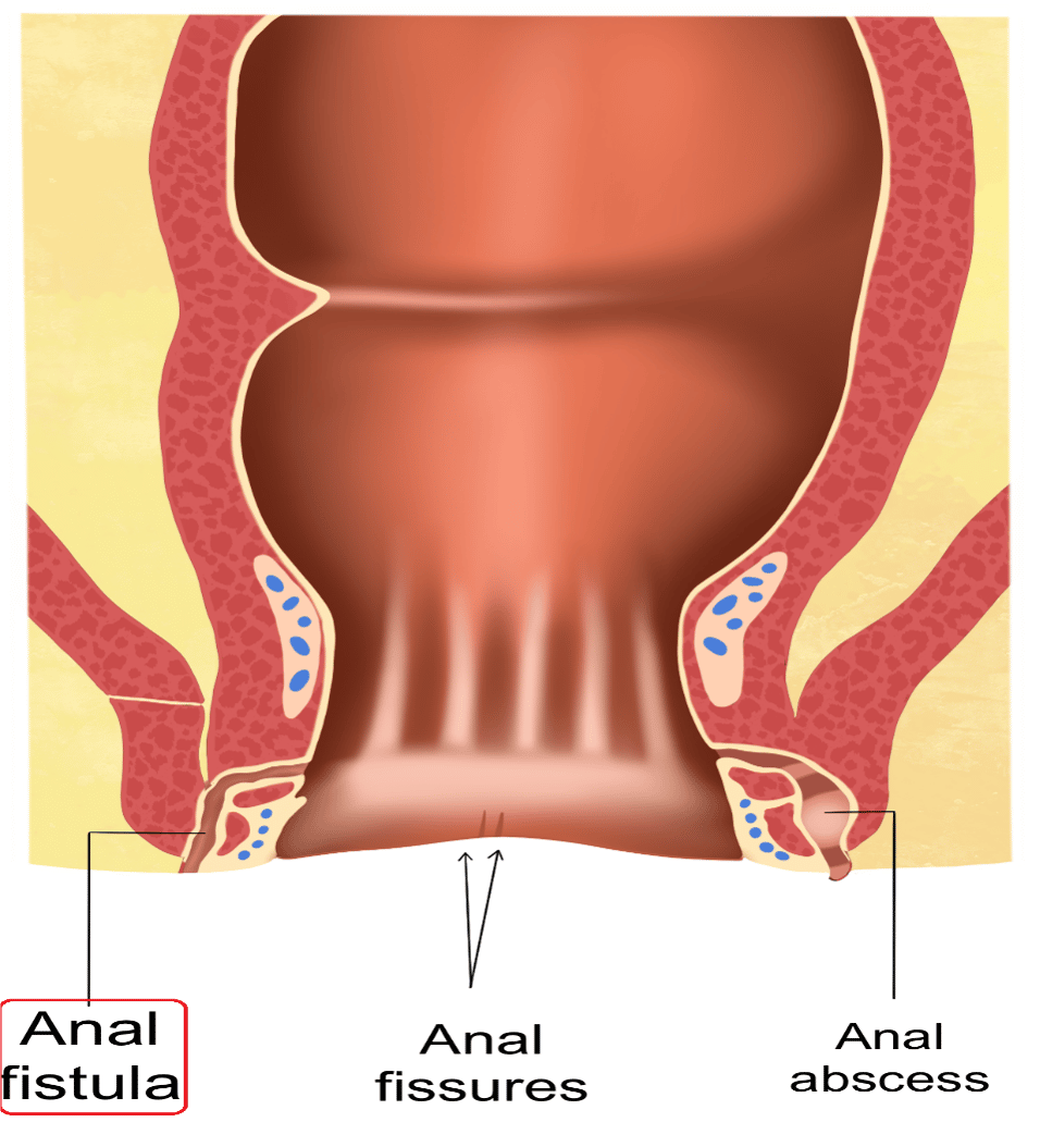 Anal Fissure Abscess And Fistula Digestive And Liver Health Specialists