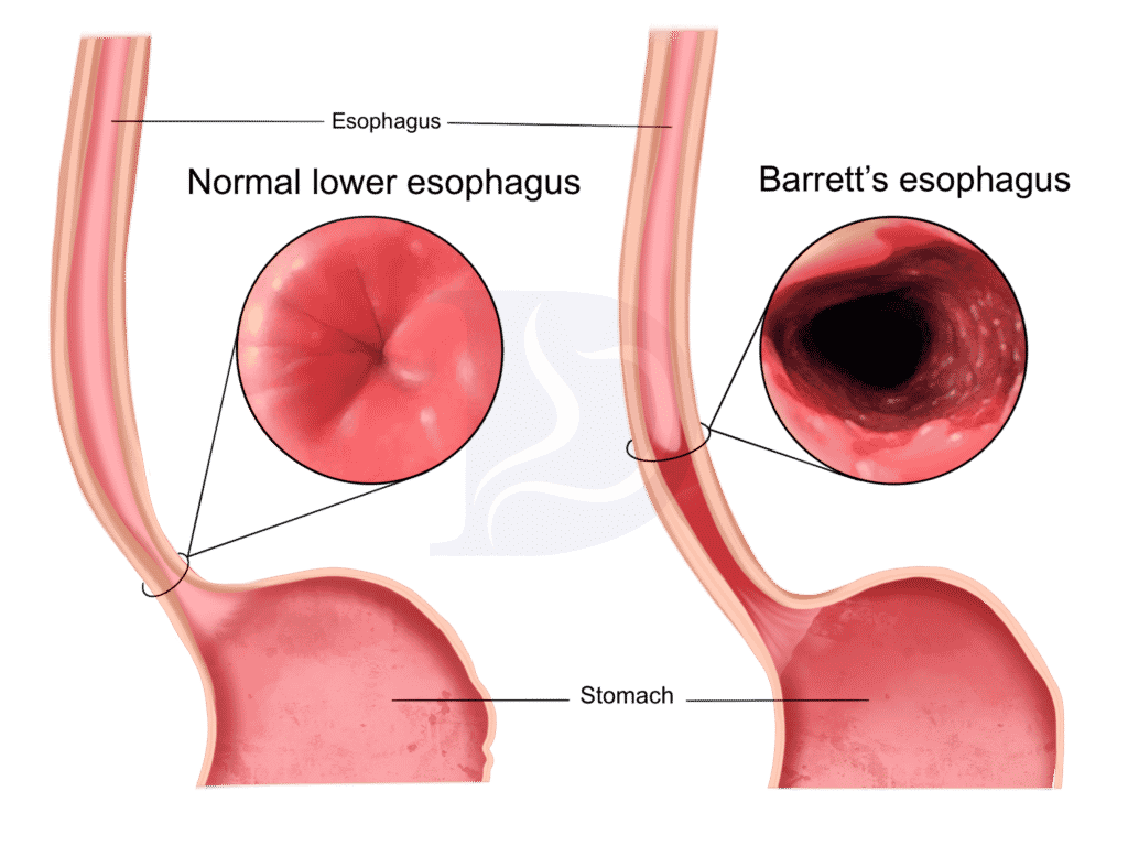 Barrett's Esophagus: causes and treatment - Digestive and Liver Health  Specialists