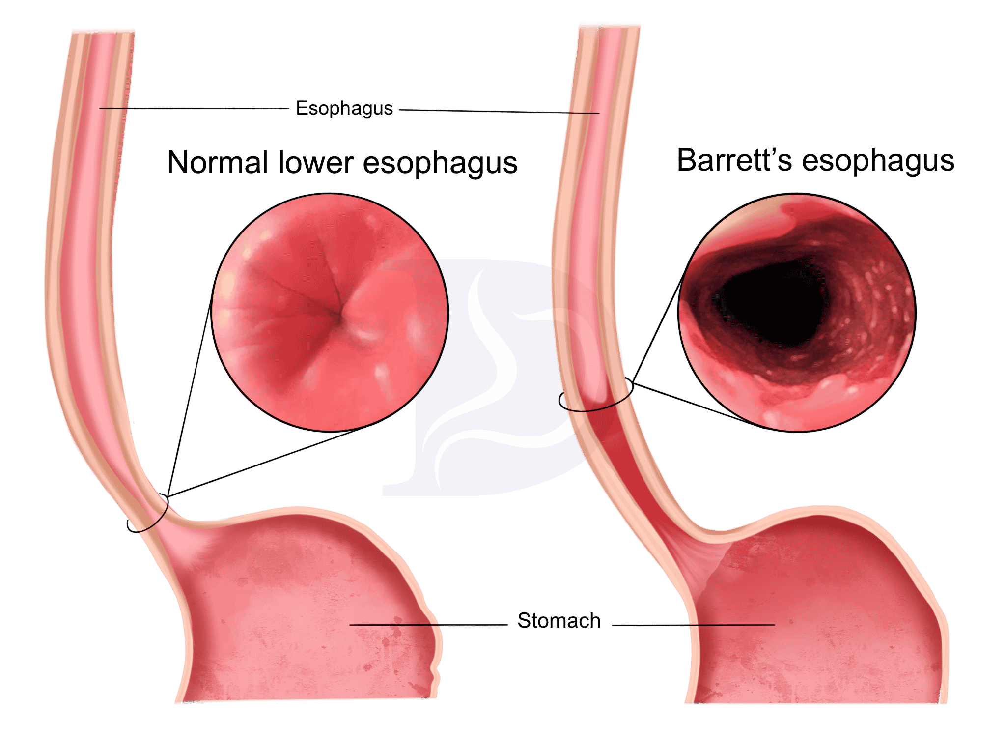 Barretts Esophagus Causes And Treatment Digestive And Liver Health