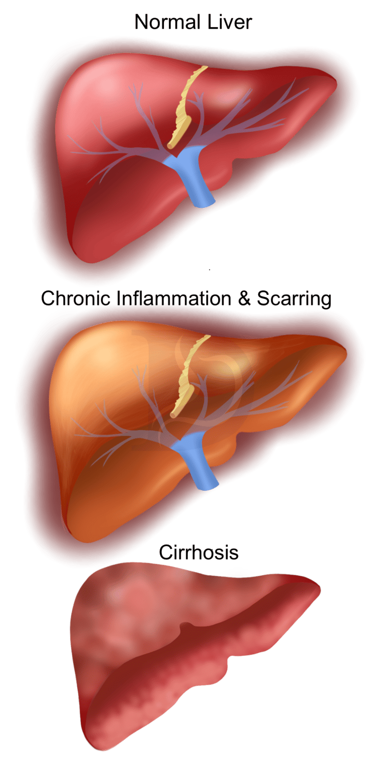 Cirrhosis Digestive and Liver Health Specialists