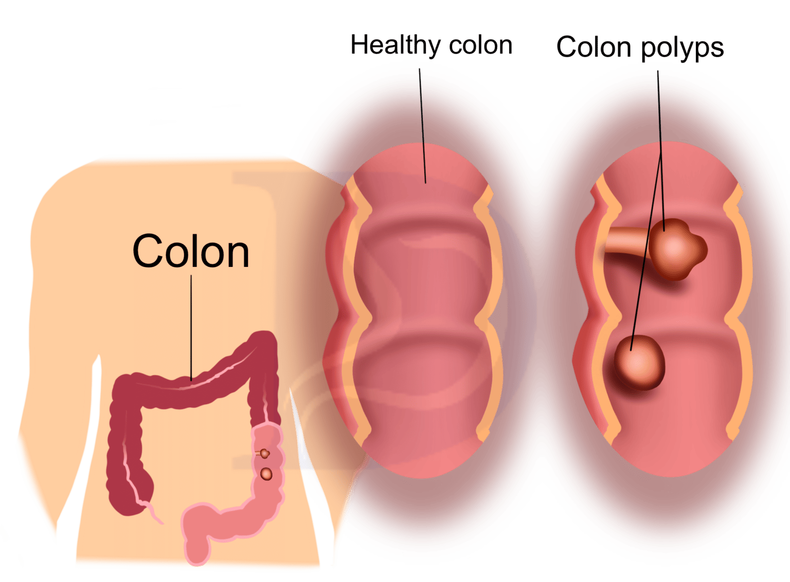 Do Colon Polyps Come Back