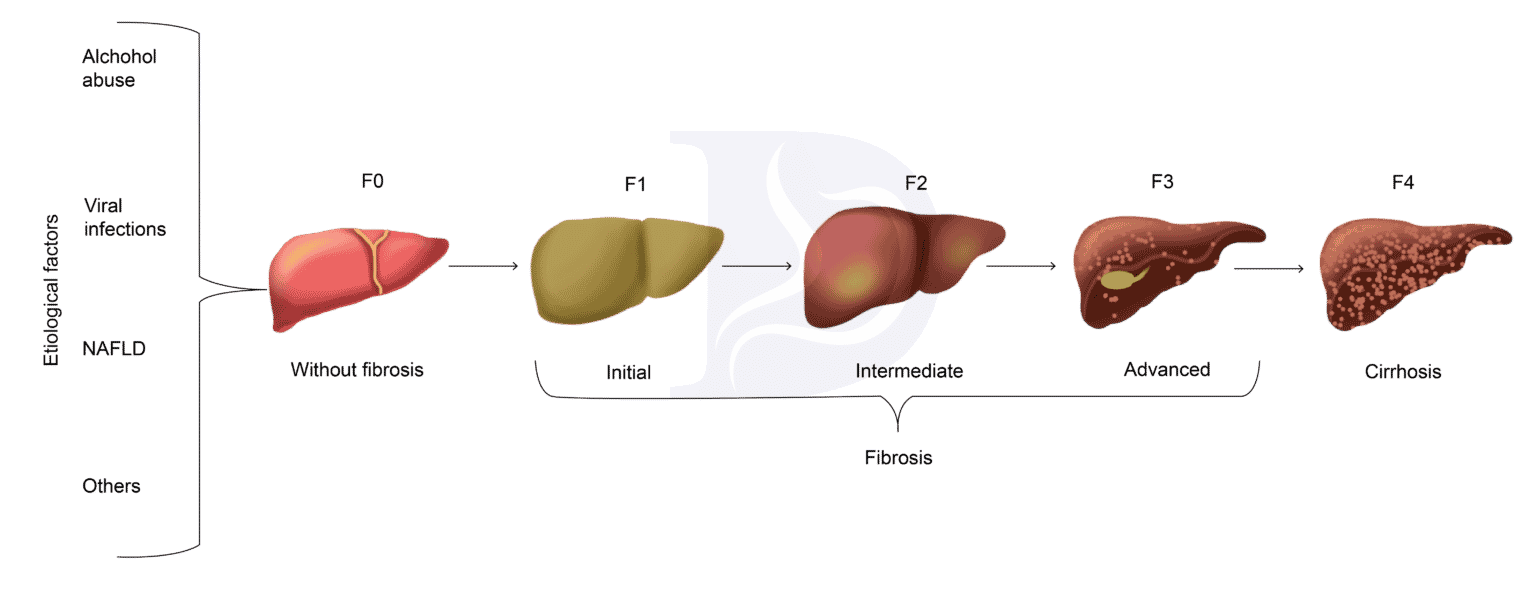 Liver Fibrosis Chart