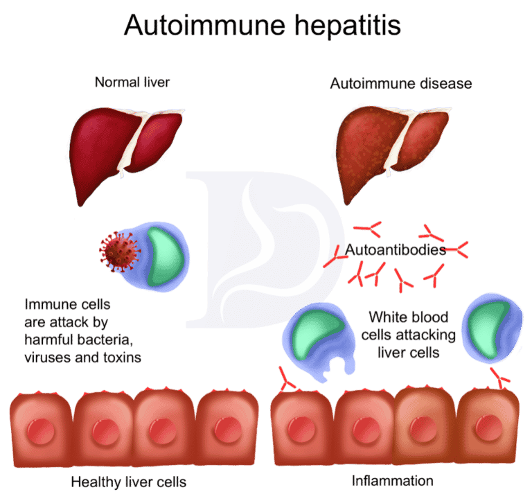 Learn About Autoimmune Hepatitis - The GI Docs