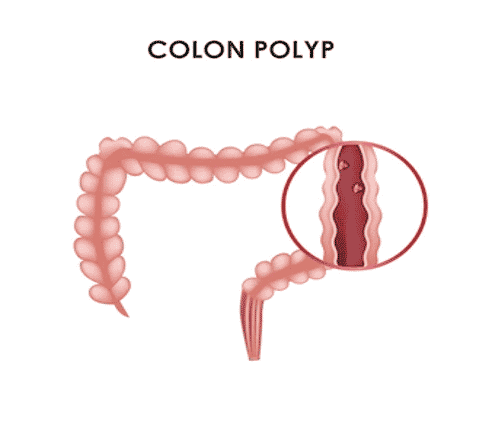 colon polyp