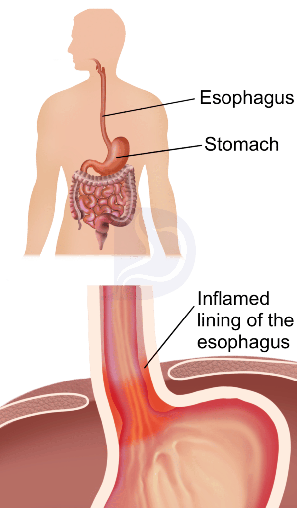 Effective Barrett's Esophagus Treatments & Solutions The GI Docs