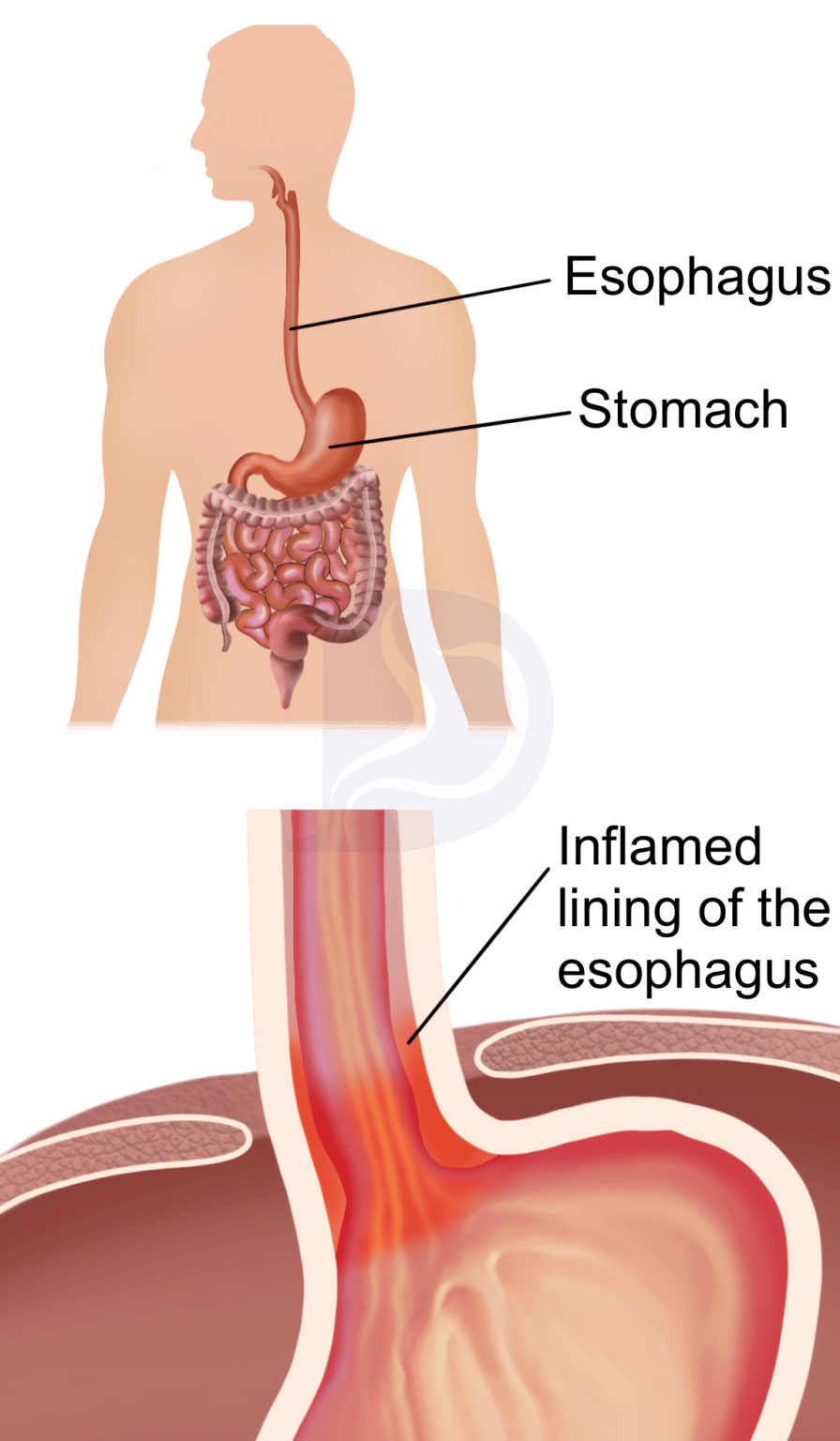 Effective Barrett's Esophagus Treatments & Solutions The GI Docs