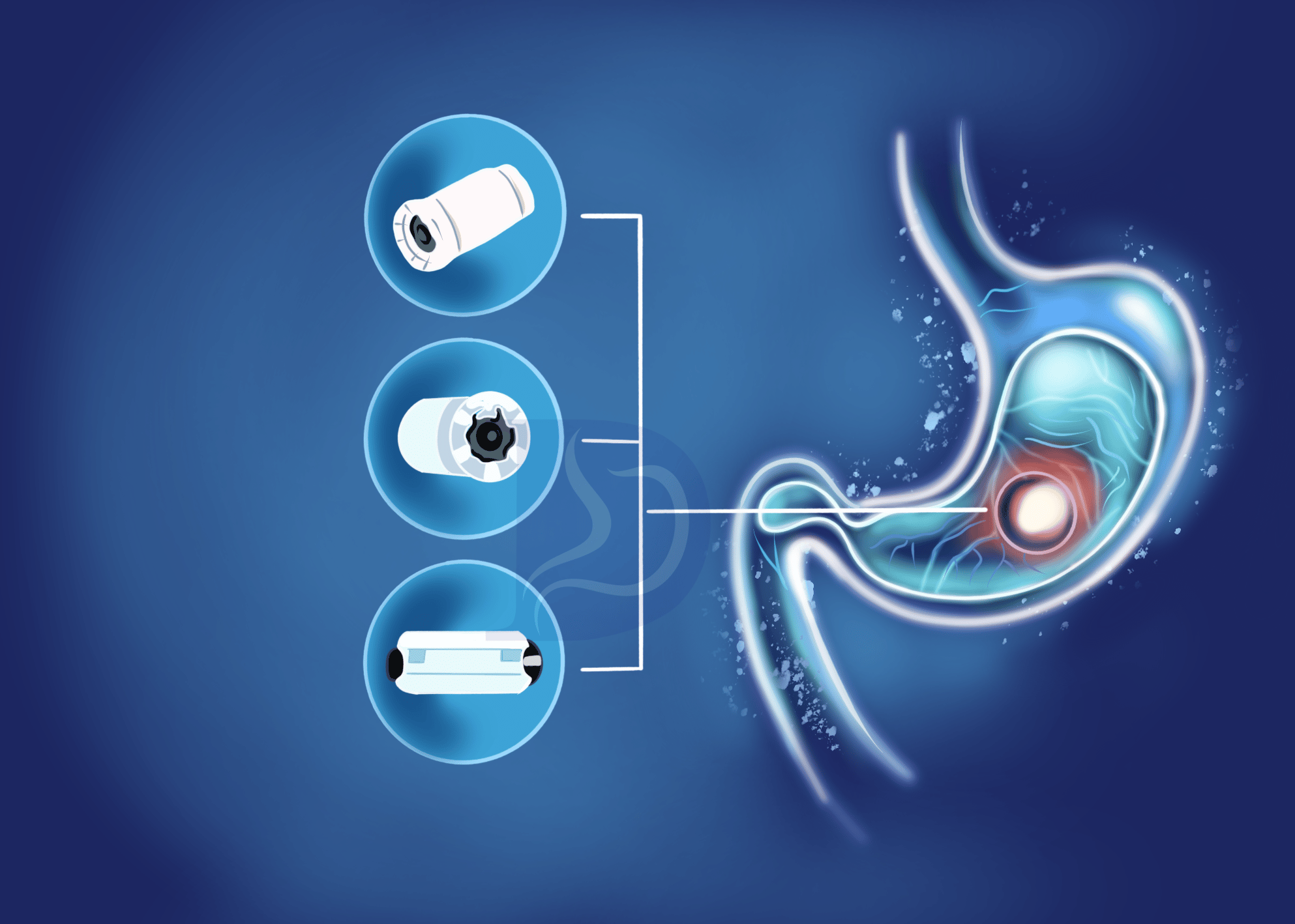 Capsule endoscopy 1