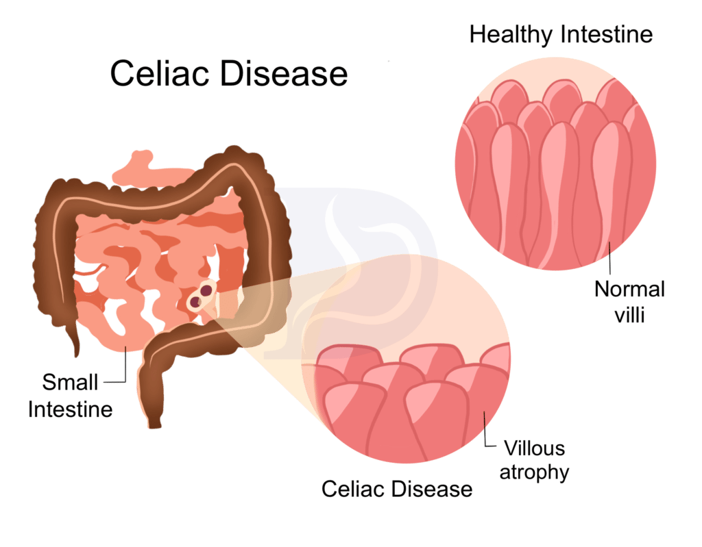 Celiac disease Digestive and Liver Health Specialists
