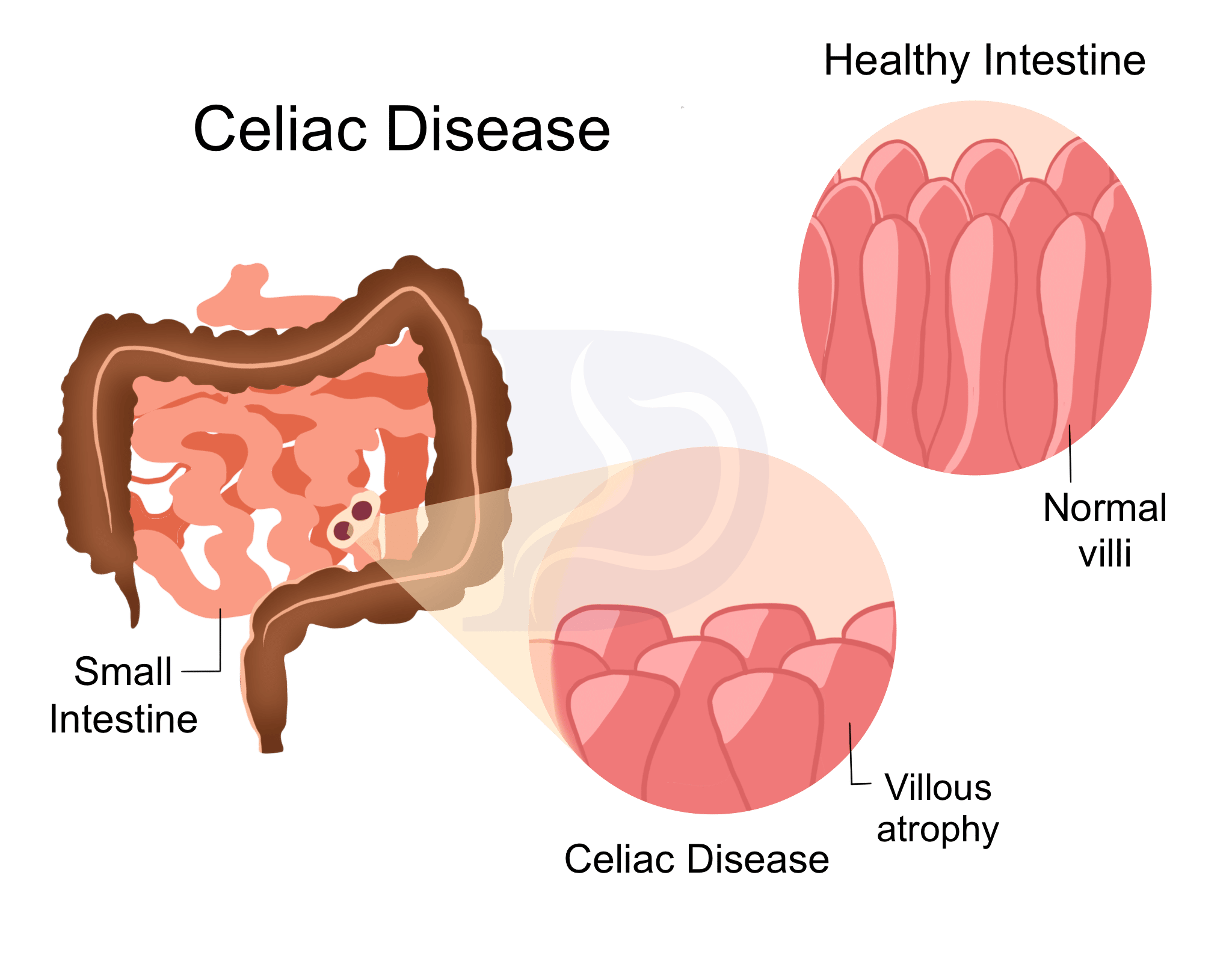 Celiac Disease Digestive And Liver Health Specialists