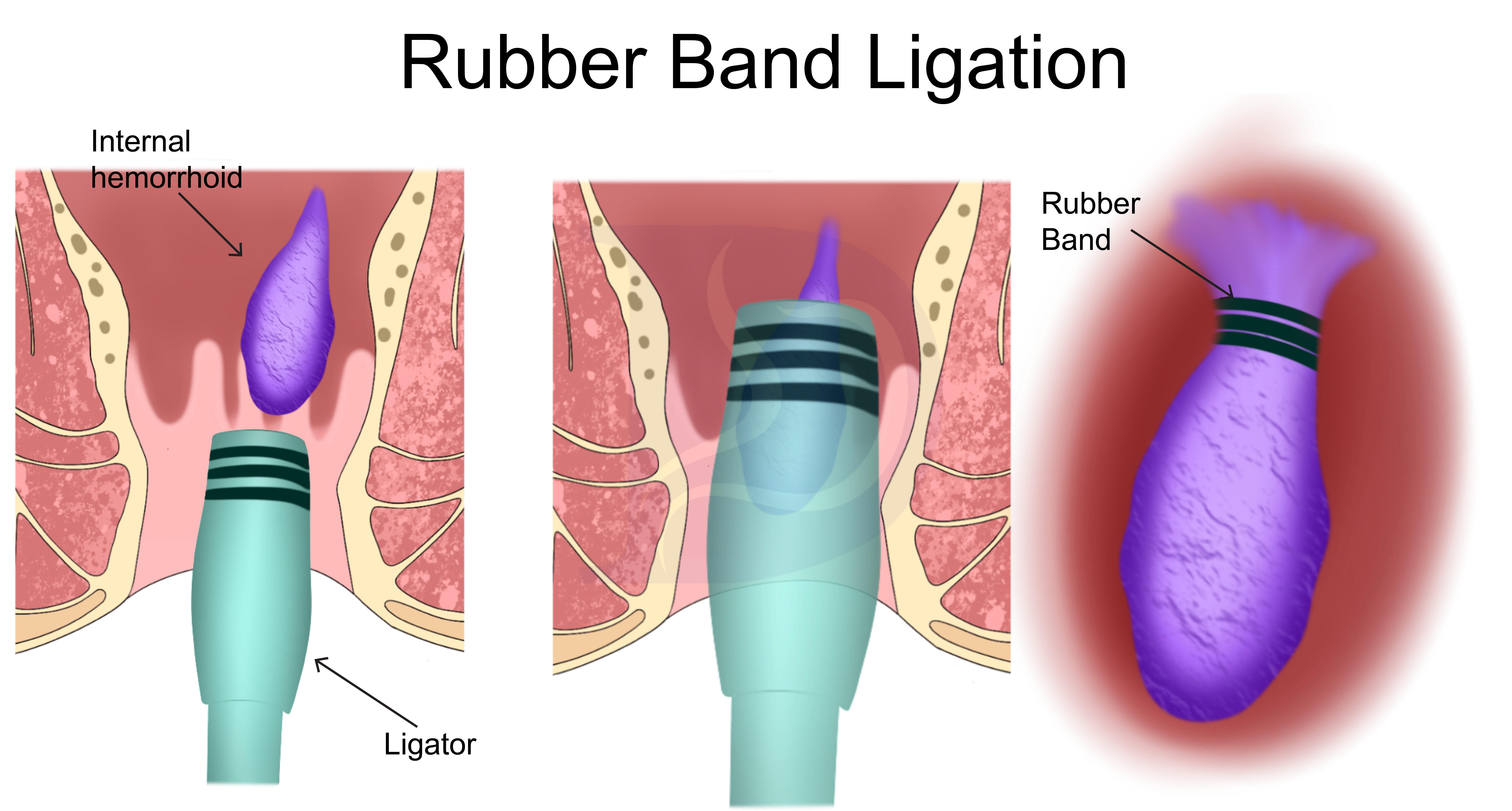 Hemorrhoid banding