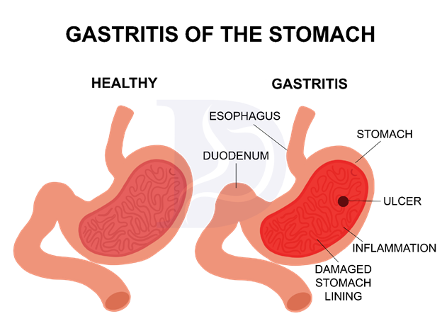 Folds In Stomach Lining