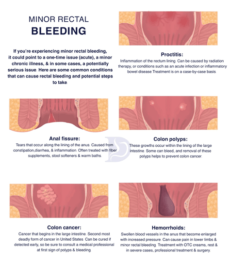 Rectal Bleeding (Blood in Stool): Causes, Colors & Treatments