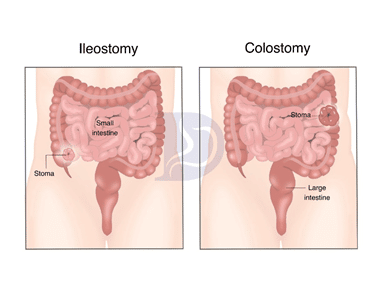 The Main Differences Between Ileostomy vs Colostomy Bag