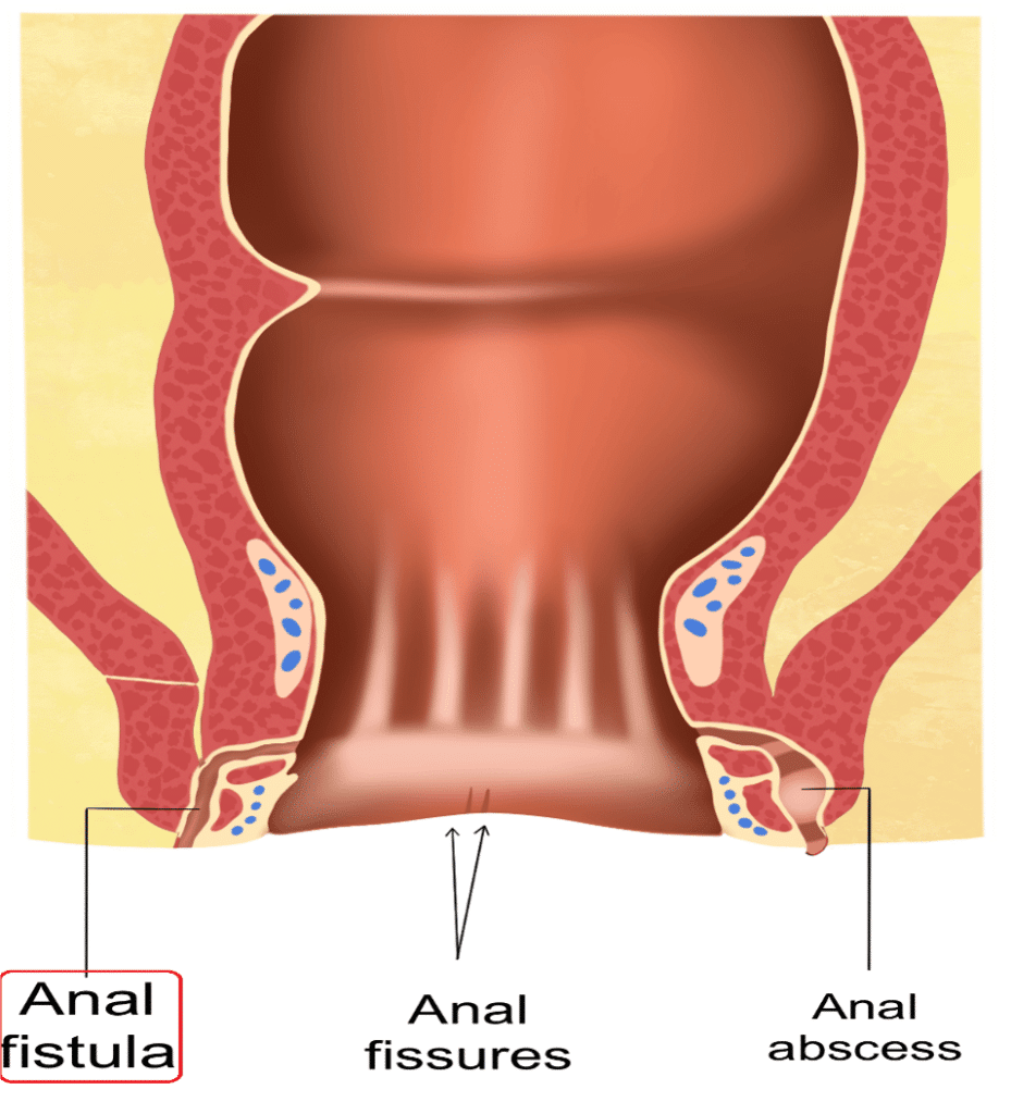 Anal Fissure Abscess And Fistula Digestive And Liver Health Specialists
