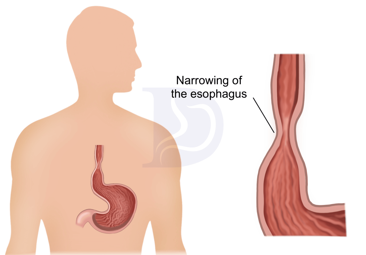 Esophageal Dilation For Optimal Digestive Health The GI Docs