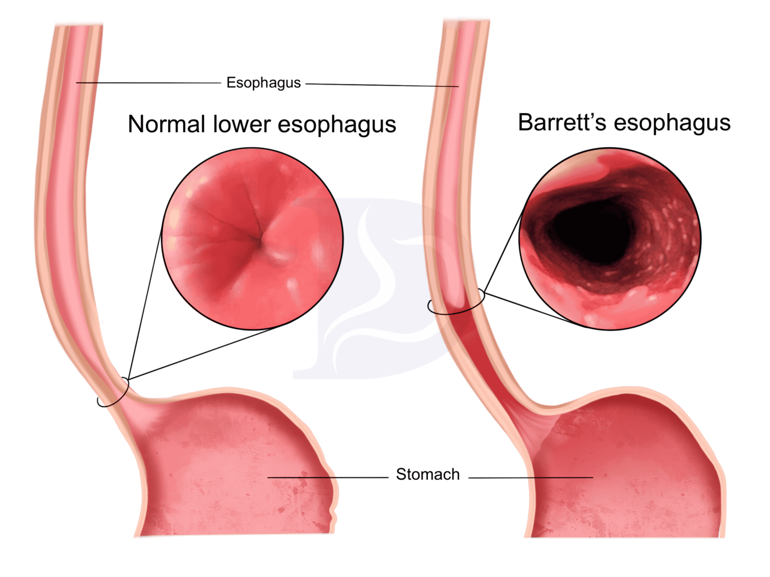 Barrett’s Esophagus Causes and Treatment Digestive and Liver Health