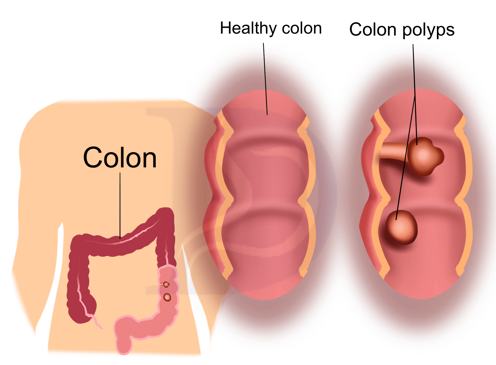 Colon Polyps 2